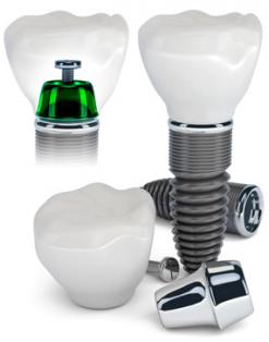 Dental Implants
